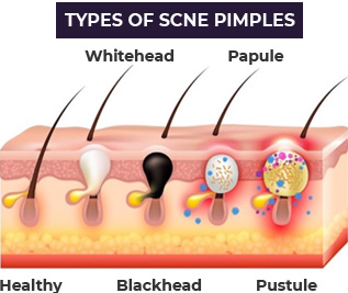 TYPES OF SCNE PIMPLES