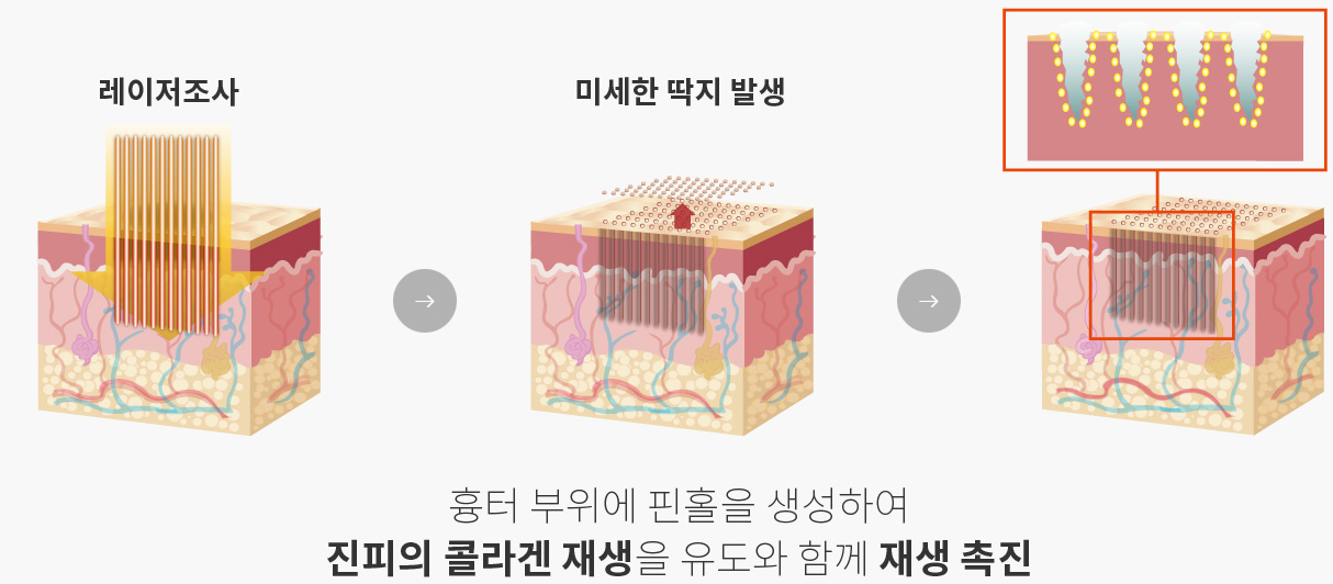 흉터 부위에 핀홀을 생성하여 진피의 콜라겐 재생을 유도와 함께 재생 촉진